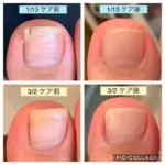 割れた爪の違和感