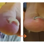 巻き爪による痛みが出なくなりました！