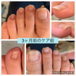 爪の食い込みが痛くて歩くのが苦痛です