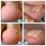 時々痛む巻き爪をどうにかしたい