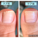 割れた爪、これ以上割れないようにしたい