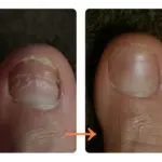 爪が割れてしまって困っていました