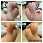 ガサガサ角質と巻き気味の爪をきれいにしたい