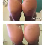 かかとの角質取り