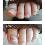 巻き爪による痛みがなくなりました