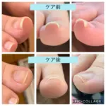 時々痛む巻き爪のケア