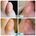 魚の目が育ってきて痛い！