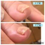 巻き爪が痛くなった