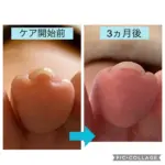 第２趾の巻き爪