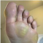 痛みのあるタコ