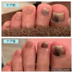 抗がん剤による爪の変色が気になります