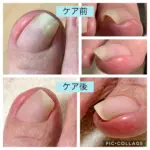爪の変形、巻き爪の爪切り