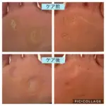 魚の目かと思う痛みの胼胝（タコ）