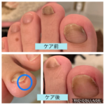 巻き爪のケアがしたい