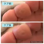 病院でケア後も痛みが続いた魚の目