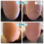 めくれてくる皮をむいてしまう