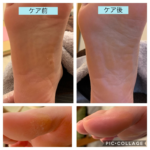 土踏まずに角質があるんです