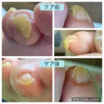 伸びすぎて指の腹に食い込む爪