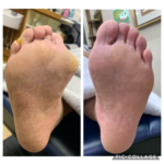 歩くときにタコが当たって痛い