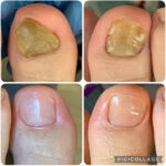 爪甲鉤彎症ケア