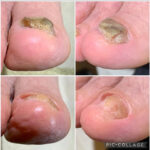 爪甲鉤彎症、爪白癬治療中