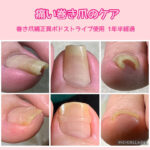 子供のころからの巻き爪