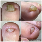 第２趾の爪甲鉤彎症