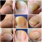 矯正具を使わない巻き爪ケア