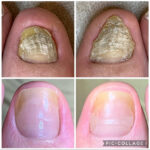 爪甲鉤彎症、2年３ヵ月の経過