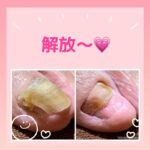 爪甲鉤彎症、離れて暮らすお母様のケア