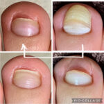 第２趾の爪甲鉤彎症