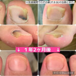 巻き爪のお悩みと爪白癬